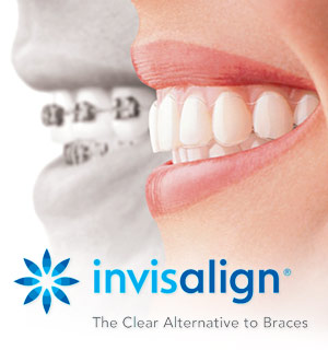 Invisalign.