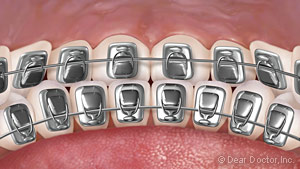 Lingual Braces.